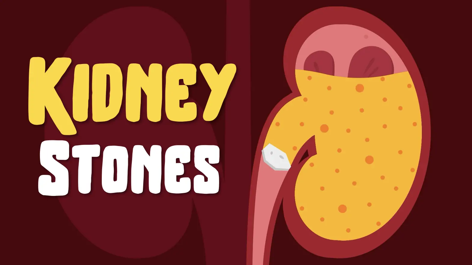 Kidney Stones